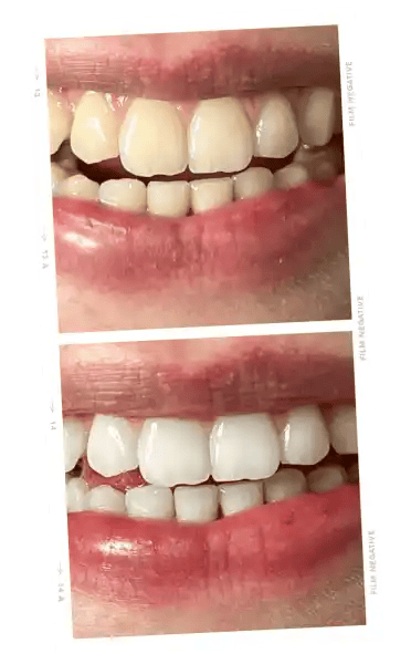 ONLYSMILE Zahnaufhellungspulver