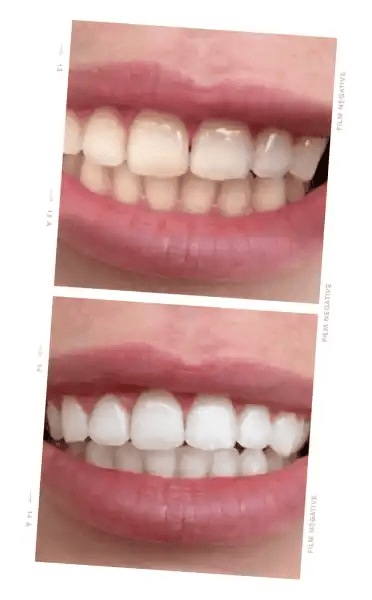 ONLYSMILE Zahnaufhellungsgel