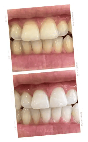 ONLYSMILE Zahnaufhellungsgel